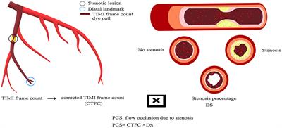 Identification of Flow-Limiting Coronary Stenosis With PCS: A New Cost-Effective Index Derived From the Product of Corrected TIMI Frame Count and Percent Diameter Stenosis